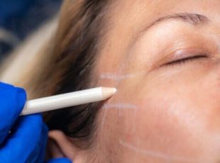 Aesthetic Mesotherapy Thread Face Lifting. Anti-aging Cosmetic Treatment